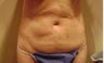Tummy Tuck