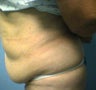 tummy tuck
