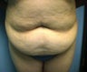 tummy tuck
