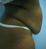 tummy tuck