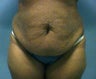 tummy tuck