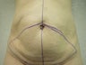Tummy tuck