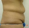 Tummy tuck