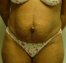 Tummy Tuck