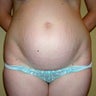Tummy Tuck