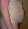 Tummy Tuck