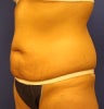 Tummy Tuck