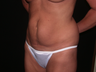 Tummy Tuck (Abdominoplasty)