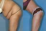 Tummy Tuck