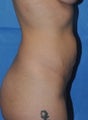 Tummy Tuck
