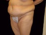 Tummy Tuck