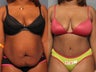 Tummy Tuck