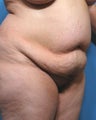 Tummy Tuck