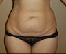 Tummy Tuck