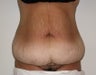 Tummy Tuck