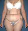 Tummy Tuck