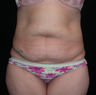 Tummy Tuck