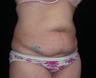 Tummy Tuck