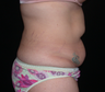 Tummy Tuck