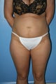 Abdominoplasty