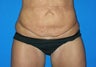 Tummy Tuck