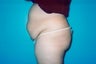 Tummy Tuck