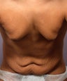 Male Body Contouring