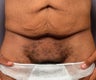 Male Body Contouring