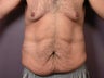 After Weight Loss