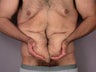 After Weight Loss