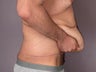 After Weight Loss Male Tummy Tuck