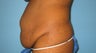 tummy tuck