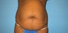 tummy tuck