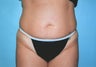 Tummy Tuck with Liposuction