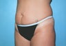 Tummy Tuck with Liposuction