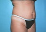 Tummy Tuck with Liposuction