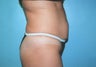 Tummy Tuck with Liposuction