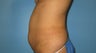 tummy tuck