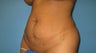 tummy tuck