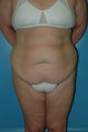 Abdominoplasty (tummy tuck)
