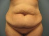 Tummy Tuck