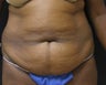 Tummy Tuck