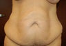 Tummy Tuck