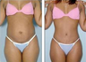 Tummy Tuck