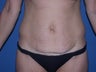Before & After Abdominoplasty