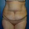 Tummy Tuck