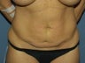 tummy tuck