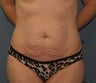 Tummy Tuck