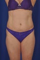 Tummy Tuck