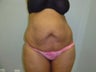 Tummy Tuck